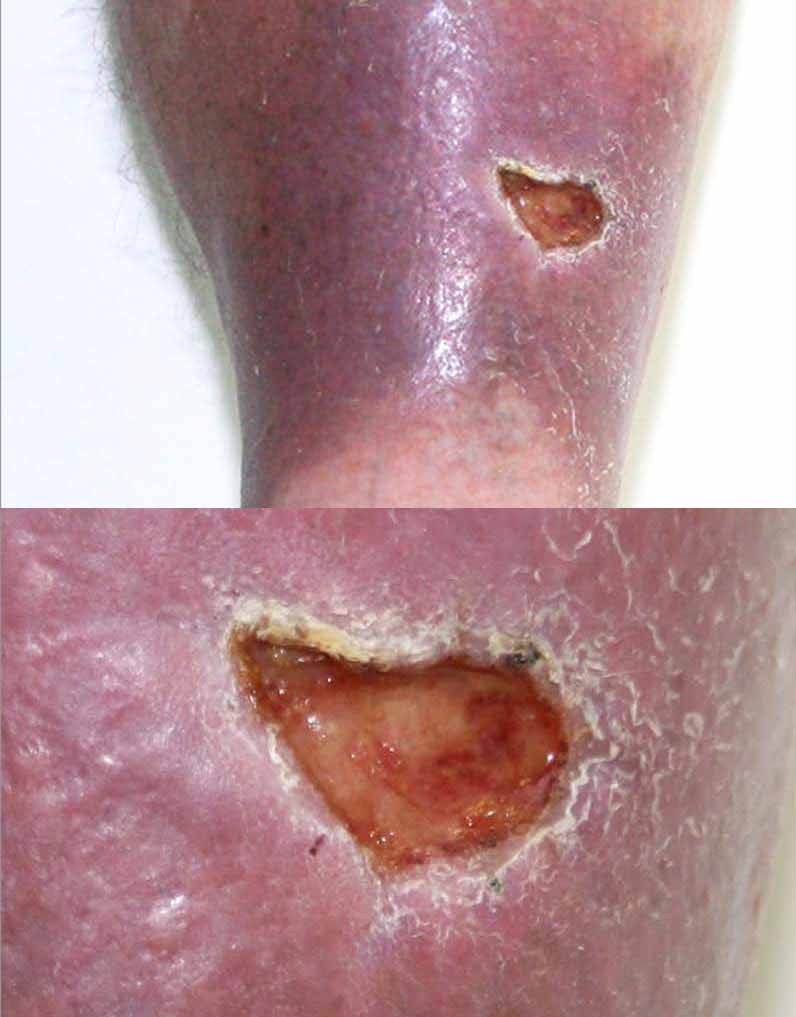 Bioflex Laser Therapy Cape Heath Centre for diabetic ulcers