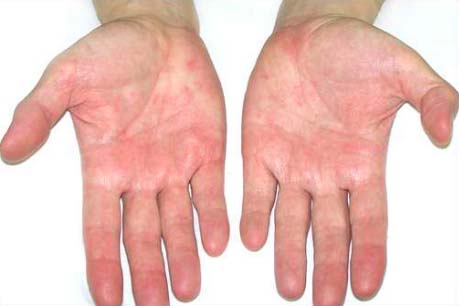 Bioflex Laser Treatment Cape Town