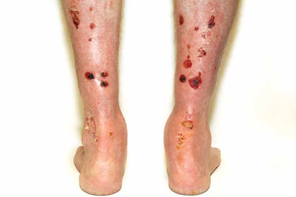 Bioflex Laser Therapy Cape Heath Centre for diabetic ulcers