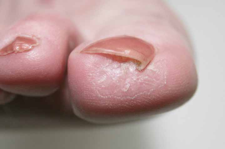 Bioflex Laser Therapy Cape Heath Centre for diabetic ulcers