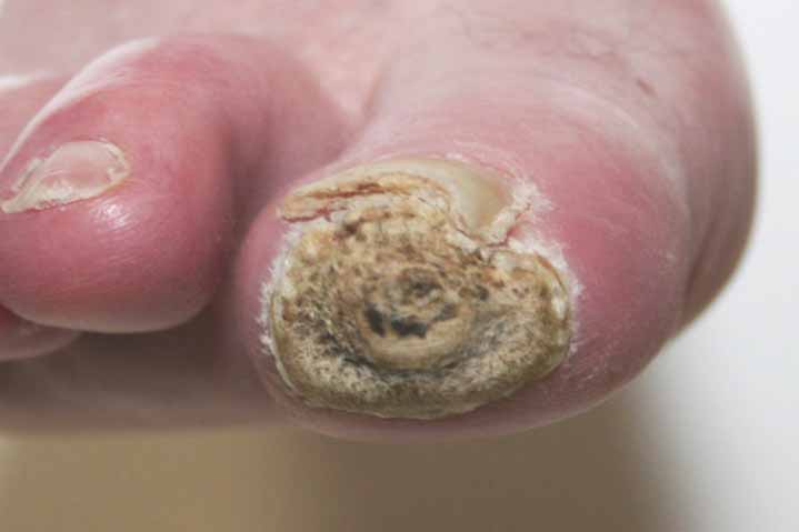 Bioflex Laser Therapy Cape Heath Centre for diabetic ulcers