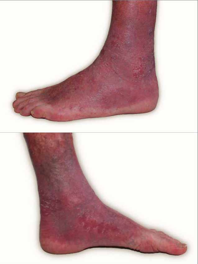 Bioflex Laser Therapy Cape Heath Centre for psoriasis