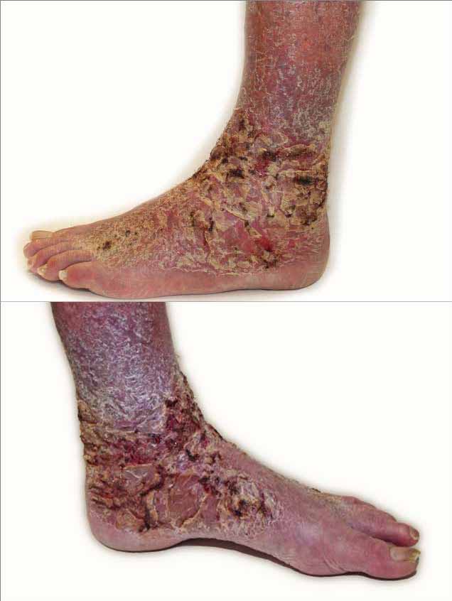 Bioflex Laser Therapy Cape Heath Centre for psoriasis